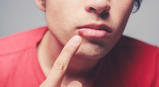virus herpes virus herpes