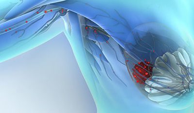 Metastasis cancer de mama biopsia liquida genolife
células circulantes tumorales
CTCs