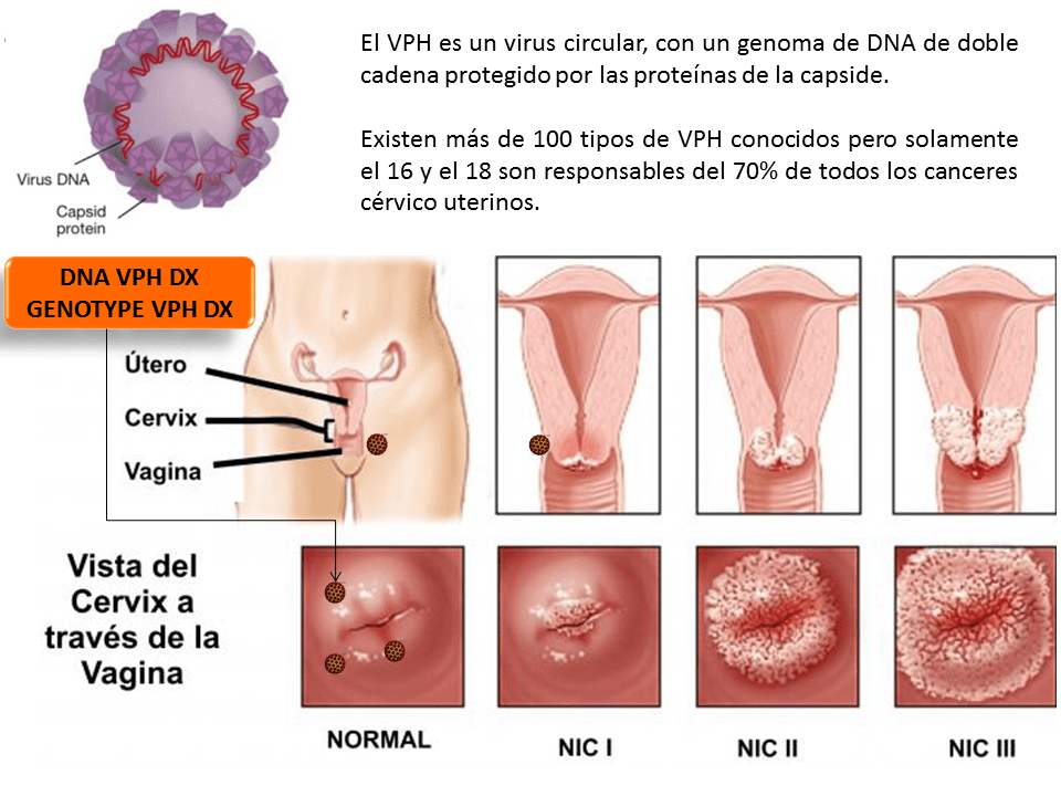 virus del papiloma genotipo 16)